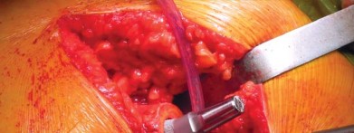 صورة طبية: تقنية الجذع القصير لاستبدال مفصل الورك الكلي: نهج الأستاذ الدكتور محمد هطيف لتدخل جراحي أقل ونتائج أفضل