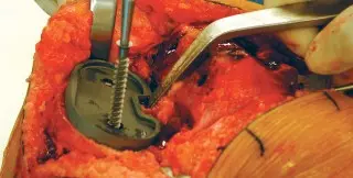 صورة توضيحية لـ جراحة استبدال المفاصل بدون أسمنت: دليل شامل للمرضى مع الأستاذ الدكتور محمد هطيف في صنعاء