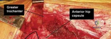 Protecting Retinacular Vessels During Capsulotomy