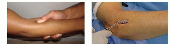 Radial Nerve Decompression