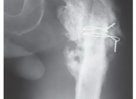Illustration 13 for Beyond Amputation: Total Femur Resection with Endoprosthetics