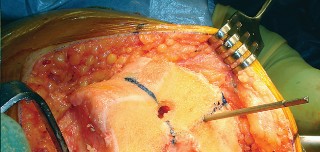 Illustration 36 for Mastering TKA: Essential Methods of Rotational Alignment