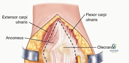 Illustration 7 for Optimizing ORIF for Distal Humerus: Prevent Class II HO