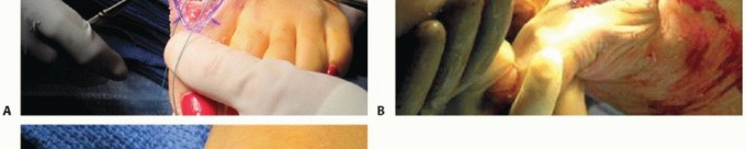 Illustration 38 for End Articular Cartilage Loss: Arthrosurface HemiCAP Resurfacing