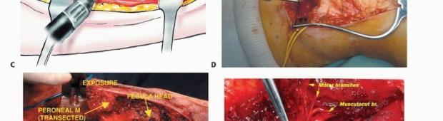 صورة طبية: استئصال أورام الشظية: دليل شامل للعلاج الحديث والحفاظ على الأطراف مع الأستاذ الدكتور محمد هطيف