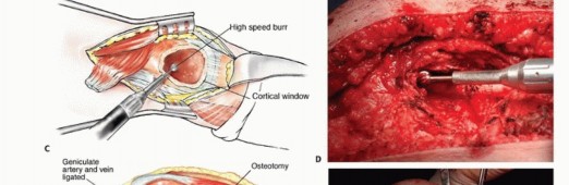 صورة طبية: النقائل العظمية الفخذية: دليل شامل للعلاج واستعادة الوظيفة مع الأستاذ الدكتور محمد هطيف في صنعاء