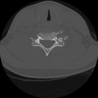 Illustration of oncology cases osteoblastoma - Dr. Mohammed Hutaif