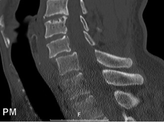 Illustration 14 for Adjacent Segment Degeneration: Your Next Spine Case Solved