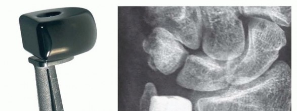 Illustration of ulnar head replacement - Dr. Mohammed Hutaif