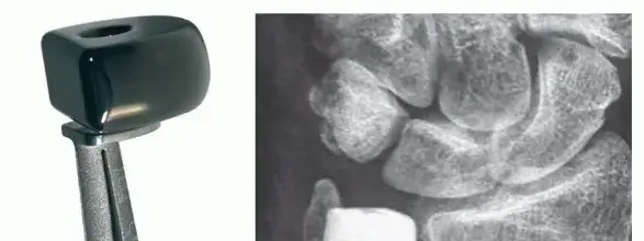 صورة توضيحية لـ استبدال مفصل رأس الزند الصناعي: أمل جديد لتخفيف آلام الرسغ في اليمن والخليج