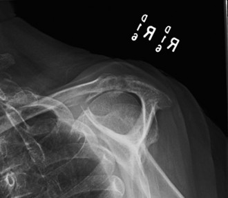 Illustration 33 for Right Shoulder Pain? Avoid This Common X-ray Mistake.