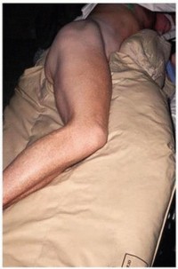 Illustration 2 for Hip Arthrodesis: The Definitive Hip Solution for Active Young Adults