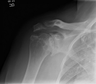 Illustration 26 for Right Shoulder Pain? Avoid This Common X-ray Mistake.