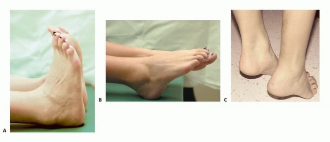 صورة طبية: استئصال ورم العضلة النعلية: دليل شامل لحماية عضلة الساق والتعافي الكامل في صنعاء مع الأستاذ الدكتور محمد هطيف