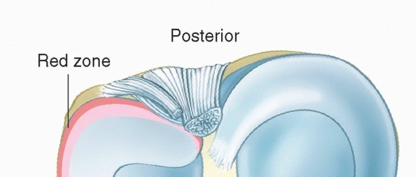 Illustration of arthroscopic partial meniscectomy - Dr. Mohammed Hutaif
