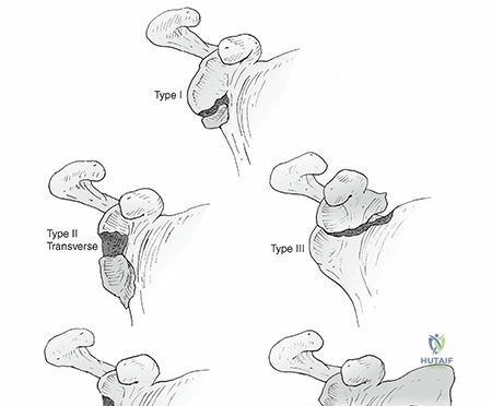 Illustration of scapula fractures scapula - Dr. Mohammed Hutaif