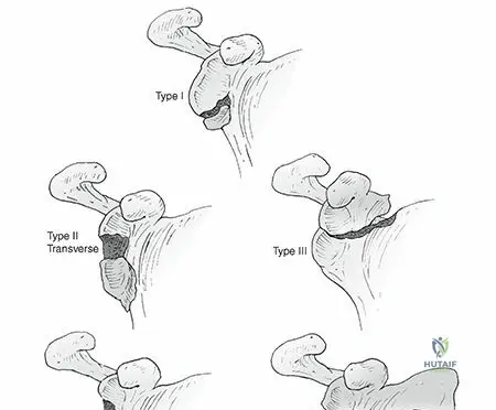 Illustration of scapula fractures scapula - Dr. Mohammed Hutaif
