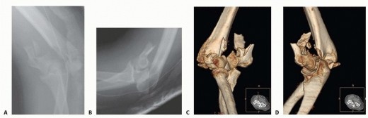 Optimizing ORIF for Distal Humerus: Prevent Class II HO