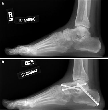 Illustration 16 for First Metatarsal Surgery: Expert Solutions for Foot & Ankle Pain
