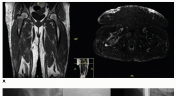 Allograft Prosthetic Composite: Mastering Proximal Femur Reconstruction