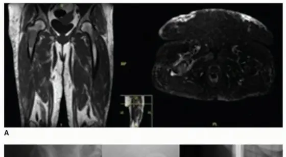 صورة توضيحية لـ إعادة بناء الجزء العلوي من عظم الفخذ: تقنيات الطعم العظمي الاصطناعي والمفصل الداخلي مع الأستاذ الدكتور محمد هطيف في صنعاء