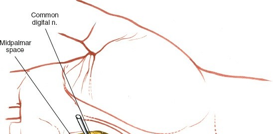 Illustration 228 for Essential Surgical Approaches: Uncover Every Aspect of the Wrist