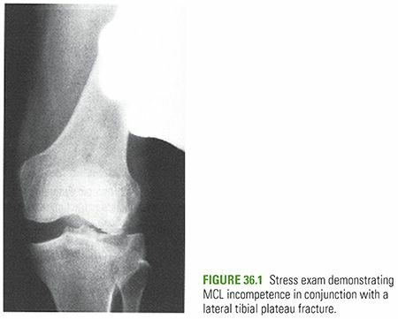 Illustration of plateau fractures tibial - Dr. Mohammed Hutaif