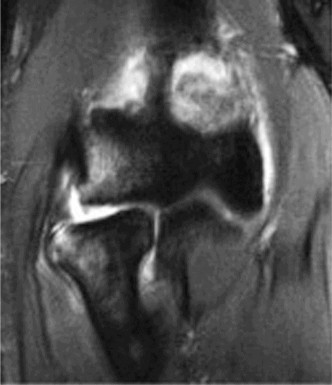 Illustration of elbow cases posterolateral - Dr. Mohammed Hutaif