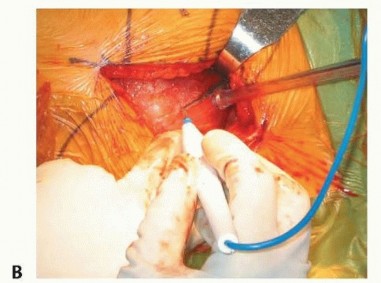 صورة طبية: نصف مفصل الورك: دليلك الشامل لدواعي الاستخدام والأنواع في صنعاء