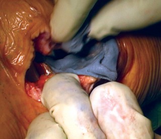 Illustration 37 for Cemented TKA Figure: Your Visual Guide to Surgical Success