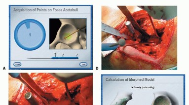صورة طبية: ترميم مفصل الورك: الحل الأمثل للحفاظ على عظم رأس الفخذ في صنعاء مع الدكتور محمد هطيف