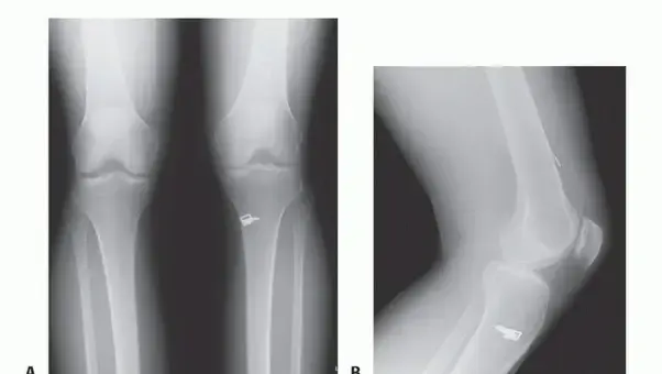 إعادة بناء الرباط الصليبي الأمامي الترميمية: دليلك الشامل لاستعادة الثبات والحركة في الركبة مع الأستاذ الدكتور محمد هطيف