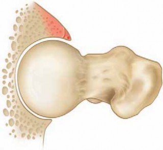 Resolving Femoral Head Neck Impingement: Arthroscopic FAI Solutions