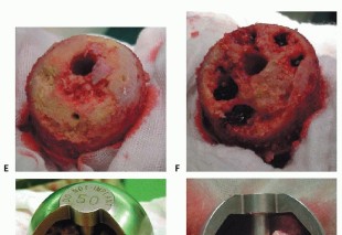 صورة طبية: ترميم مفصل الورك: الحل الأمثل للحفاظ على عظم رأس الفخذ في صنعاء مع الدكتور محمد هطيف