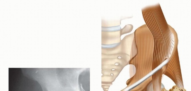 Illustration of femoral head fixation - Dr. Mohammed Hutaif