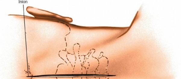 Mastering the Posterior C1-2 Vertebral Space Surgical Approach
