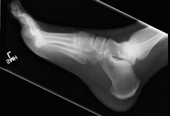 Foot & Ankle Cases: Crucial Figure MRI Sagittal Insights