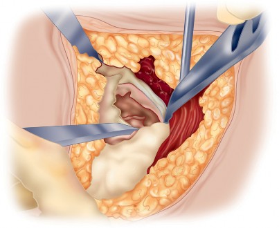 Illustration 37 for Unlock the Figure Posterior Approach to the Hip