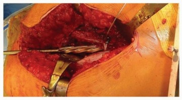 Illustration 14 for Optimizing Revision THA with Tapered Fluted Titanium Stems