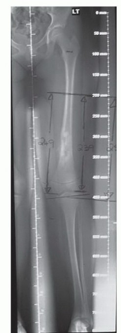 صورة توضيحية لعملية التشخيص الدقيق للأورام العظمية لدى الأطفال مع الأستاذ الدكتور محمد هطيف