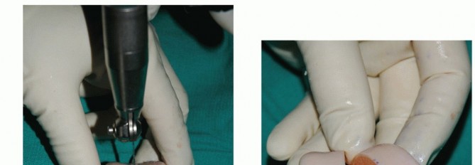 Illustration 35 for Unlock Healing: Medial Malleolar Osteotomy for Talus OLT Allografts