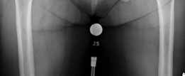 Illustration 2 for Primary Uncemented Total Hip Arthroplasty: A Case Study Title