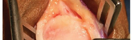 Illustration 4 for MTP Joint Arthrodesis: The Key to Optimal Toe Positioning