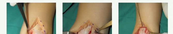 Is Structural Allograft Osteochondral Repair Right for Your Talus Lesion?