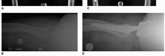 Illustration 2 for Total Hip Arthroplasty: Posterolateral Approach, Extensile & Minimally Invasive