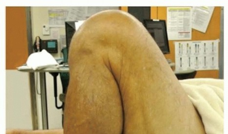 Illustration 27 for Unicondylar Knee Arthroplasty: Is This Your Solution to Knee Pain?