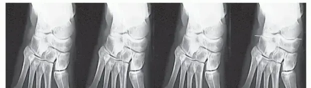 صورة توضيحية لـ إبهام القدم الأروح (الوكعة): دليل شامل للعلاج والتعافي مع الأستاذ الدكتور محمد هطيف في صنعاء