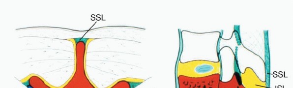 Total En Bloc Spondylectomy: Complete Resection for Spinal Tumors