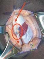 الكتف المتجمد: دليل شامل من التشخيص إلى العلاج المتقدم في اليمن