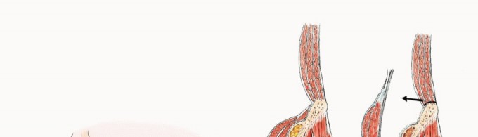 توضيح طبي: جراحة نقائل الحوض: حل شامل لآلام العظام واستعادة الحركة مع الأستاذ الدكتور محمد هطيف